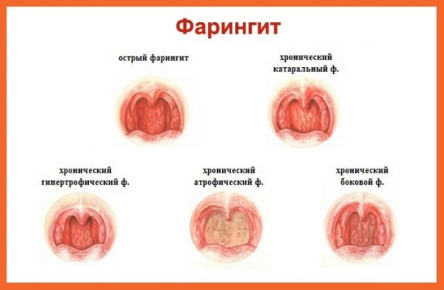 Чем отличается фарингит от тонзиллита и как проявляются их симптомы Чем отличается фарингит от тонзиллита и как проявляются их симптомы