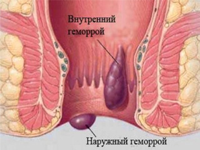 Кровь при дефекации: причины и лечение Кровь при дефекации: причины и лечение