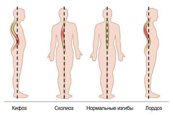 Сколиоз кифоз Сколиоз кифоз
