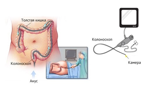 Колоноскопия Колоноскопия