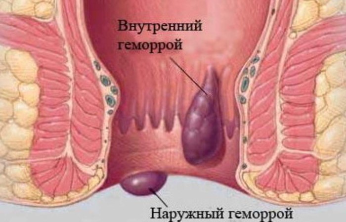 Почему возникает кровь из прямой кишки? Почему возникает кровь из прямой кишки?