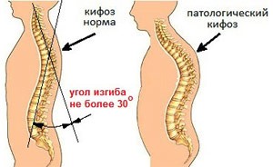 Как лечить кифоз Как лечить кифоз