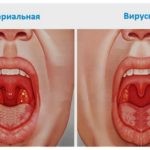 Амоксициллин от ангины: когда его назначают? Амоксициллин от ангины: когда его назначают?
