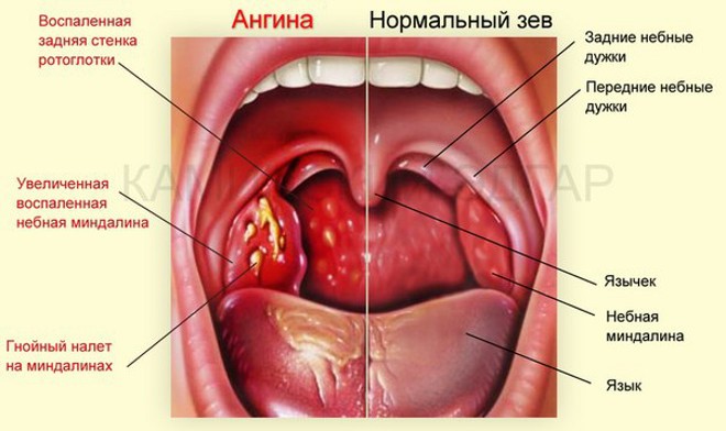 Ангина и температура: возможно ли одно без другого? Ангина и температура: возможно ли одно без другого?