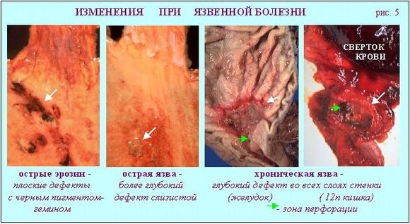 Симптомы и лечение язвы желудка в период обострения Симптомы и лечение язвы желудка в период обострения