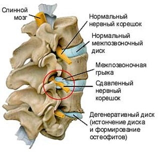 Основные симптомы остеохондроза грудного отдела позвоночника Основные симптомы остеохондроза грудного отдела позвоночника