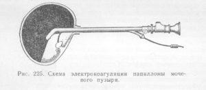 Симптомы и лечение камней в мочевом пузыре Симптомы и лечение камней в мочевом пузыре