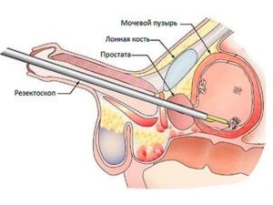 Симптомы и лечение камней в мочевом пузыре Симптомы и лечение камней в мочевом пузыре