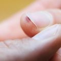 Симптомы и лечение камней в мочевом пузыре Симптомы и лечение камней в мочевом пузыре
