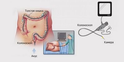Правильная подготовка к колоноскопии: диета и другие способы очистки кишечника Правильная подготовка к колоноскопии: диета и другие способы очистки кишечника