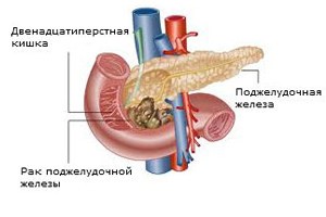 Причины, симптомы и лечение опухоли поджелудочной железы Причины, симптомы и лечение опухоли поджелудочной железы