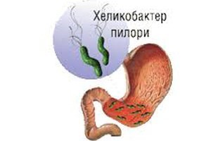 Как определить симптомы обострения гастрита с повышенной кислотностью? Как определить симптомы обострения гастрита с повышенной кислотностью?
