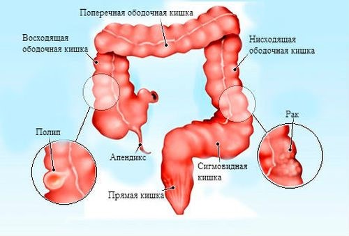 Стадии и симптомы рака сигмовидной кишки Стадии и симптомы рака сигмовидной кишки