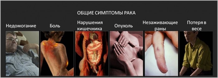 5 стадий рака желудка 5 стадий рака желудка