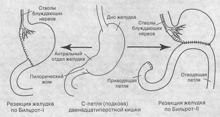 5 стадий рака желудка 5 стадий рака желудка