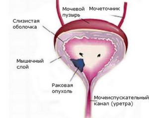От чего бывает дискомфорт в мочевом пузыре у женщин и мужчин? От чего бывает дискомфорт в мочевом пузыре у женщин и мужчин?