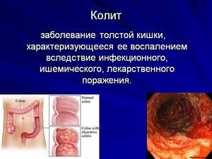 Симптоматика и лечение хронического колита у взрослых Симптоматика и лечение хронического колита у взрослых