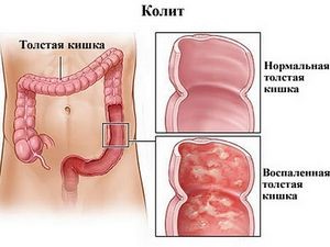 Симптоматика и лечение хронического колита у взрослых Симптоматика и лечение хронического колита у взрослых