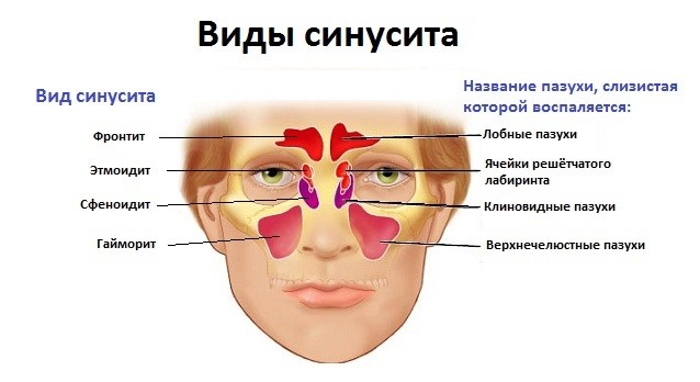 Причины развития гнойного синусита, характерные признаки, методы диагностики и особенности терапии Причины развития гнойного синусита, характерные признаки, методы диагностики и особенности терапии
