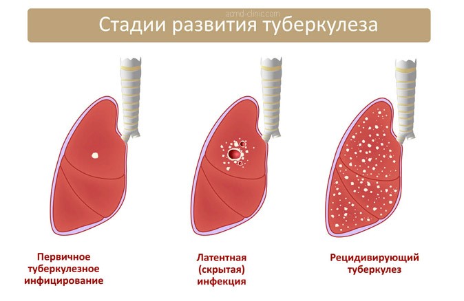 Туберкулема легких - что это такое и как выполнять лечение Туберкулема легких - что это такое и как выполнять лечение