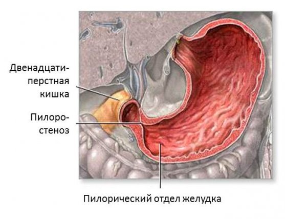 Причины тошноты и тяжести в желудке Причины тошноты и тяжести в желудке