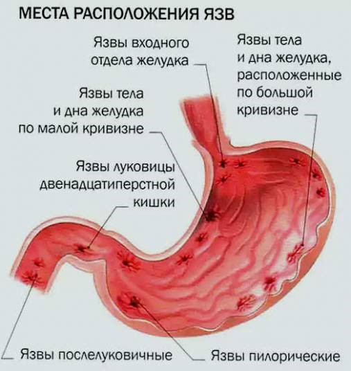 Причины тошноты и тяжести в желудке Причины тошноты и тяжести в желудке