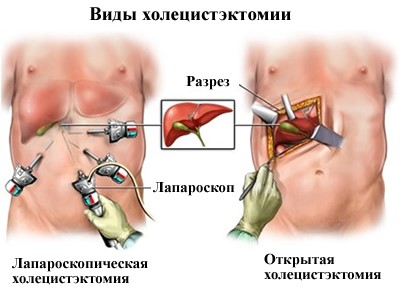 После удаления желчного пузыря проблемы с пищеварением После удаления желчного пузыря проблемы с пищеварением