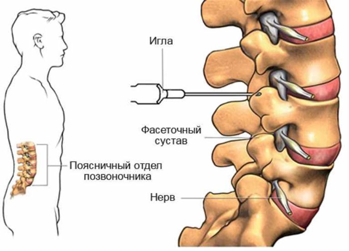 Как и какие уколы применяют при остеохондрозе поясничного отдела позвоночника? Как и какие уколы применяют при остеохондрозе поясничного отдела позвоночника?