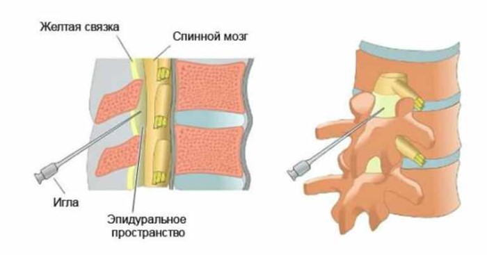 Как и какие уколы применяют при остеохондрозе поясничного отдела позвоночника? Как и какие уколы применяют при остеохондрозе поясничного отдела позвоночника?