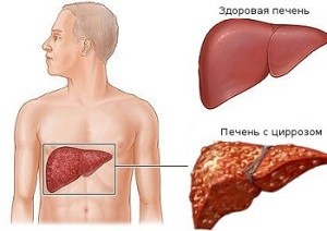 Уплотнение в печени на узи Уплотнение в печени на узи