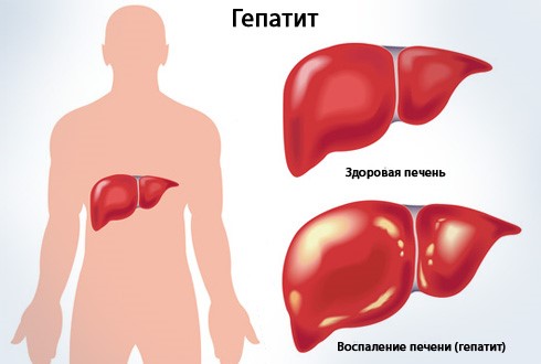 Что делать: понос и температура 38 у взрослого Что делать: понос и температура 38 у взрослого