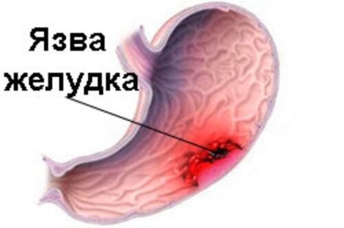 Прободная язва желудка: проявление, хирургическое вмешательство и лечение Прободная язва желудка: проявление, хирургическое вмешательство и лечение