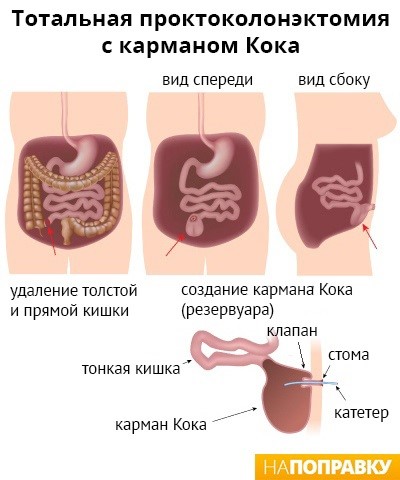 Причины развития и лечение неспецифического язвенного колита Причины развития и лечение неспецифического язвенного колита