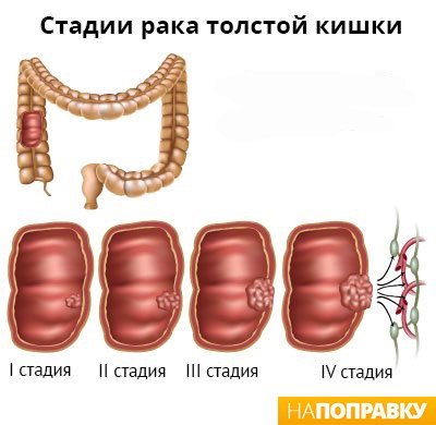 Причины развития и лечение неспецифического язвенного колита Причины развития и лечение неспецифического язвенного колита