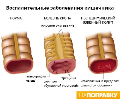 Причины развития и лечение неспецифического язвенного колита Причины развития и лечение неспецифического язвенного колита