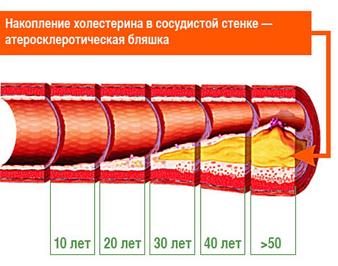 Болезни сосудов головного мозга Болезни сосудов головного мозга